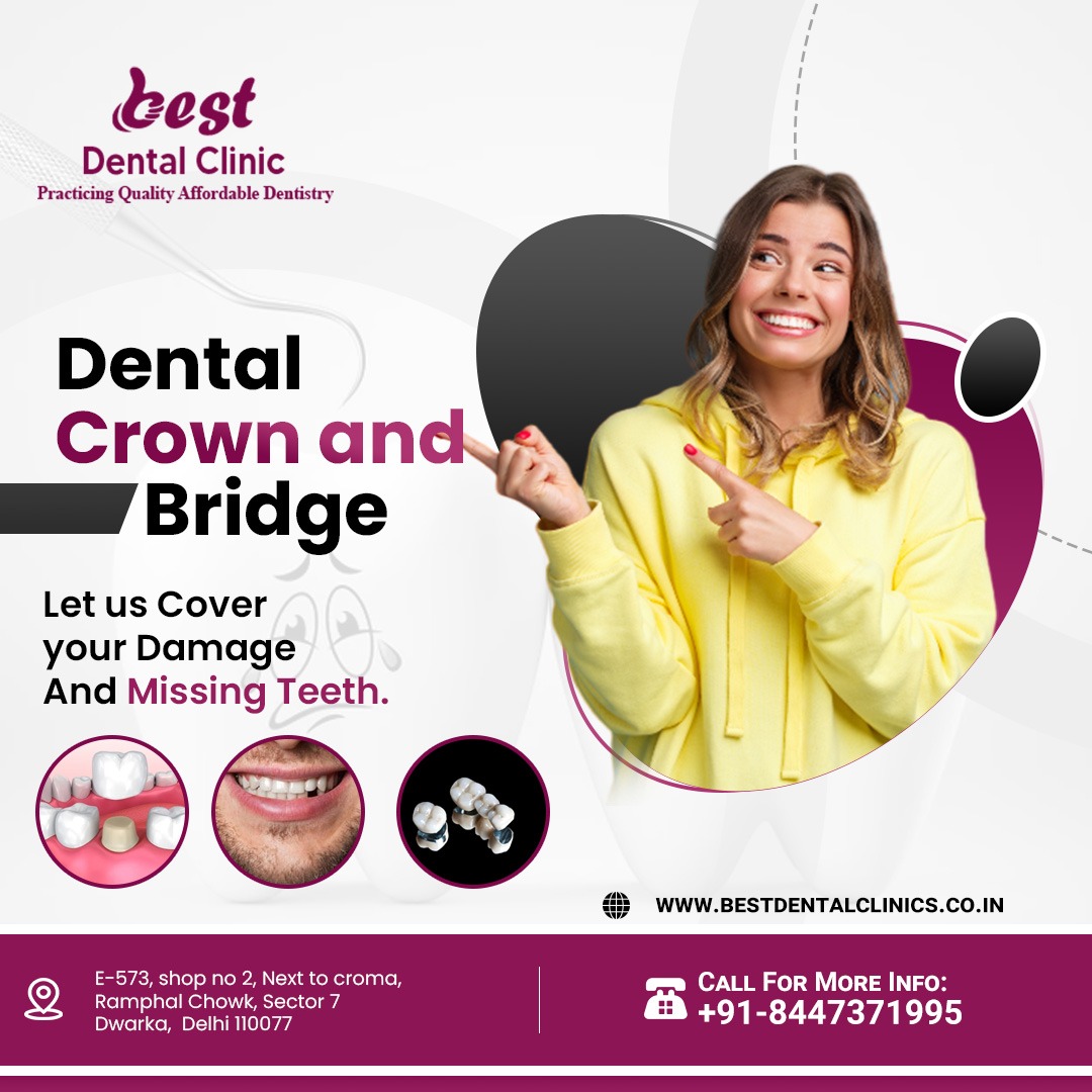 Dental Crown Bridge